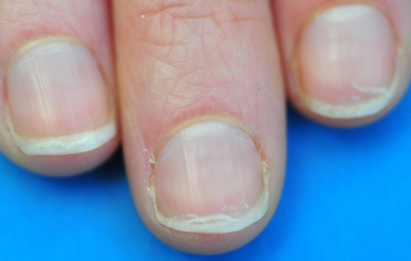 Splitting-nails