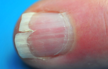 Vertical-ridging-nails